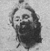 Mortuary photograph of Eddowes. Her lower face is severely mutilated