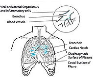 Acute-bronchitis.jpg