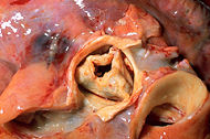 Aortic stenosis rheumatic, gross pathology 20G0014 lores.jpg