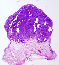 Bladder inverted papilloma histopathology (3).jpg
