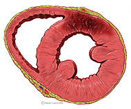 Heart ant wall infarction.jpg