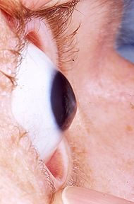 Keratoconus eye.jpg