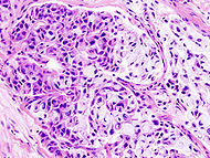Mucoepidermoid carcinoma (2) HE stain.jpg