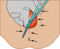 Medio-lateral-episiotomy-blank.png