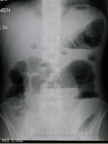 Bowel Obstrution2008.jpg