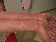 Eczema-arms.jpg