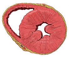 Heart left ventricular hypertrophy sa.jpg