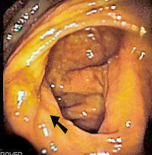 Ileocecal valve.jpg