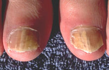 Onychomycosis due to Trychophyton rubrum, right and left great toe PHIL 579 lores.jpg