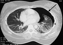 Pneumothorax CT.jpg