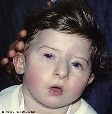 Prader Willi Syndrome1.jpg