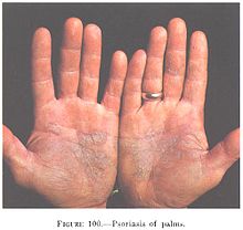 Psoriasis of the palms.jpg