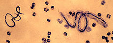 Filariasis Microfilariae of Loa loa (right) and Mansonella perstans (left) DPDx.JPG