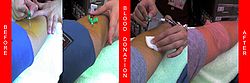Blood donation needle.jpg